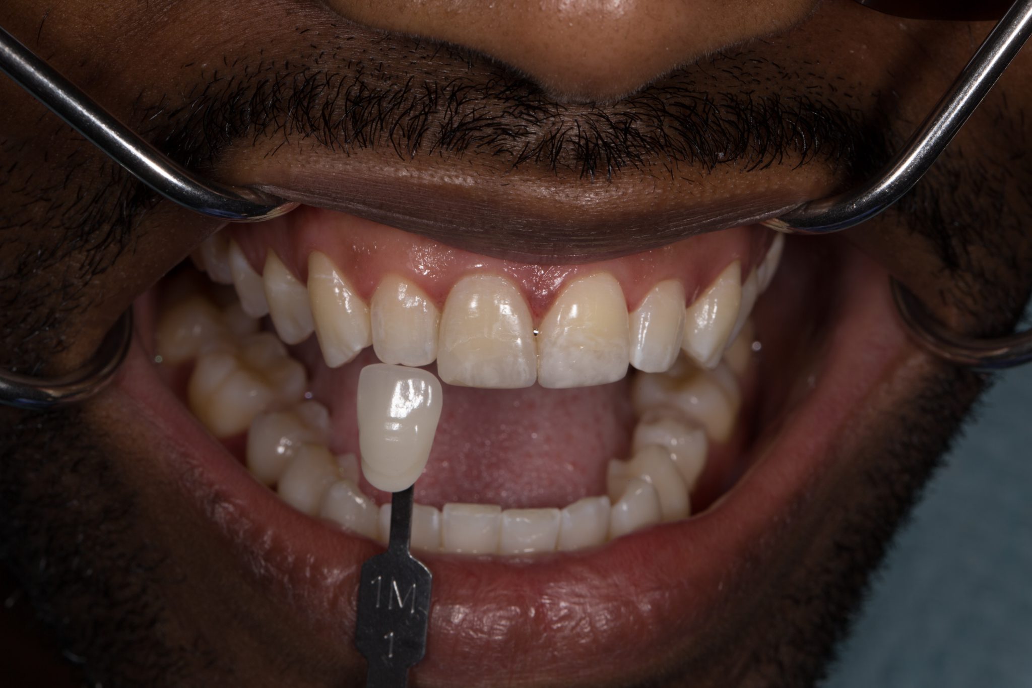 Cosmetic Dentistry Matching or Beating Nature Dr. Fantaski