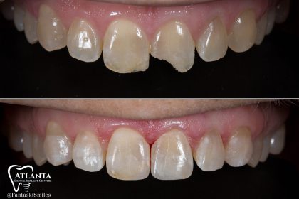 Bonding Front Tooth