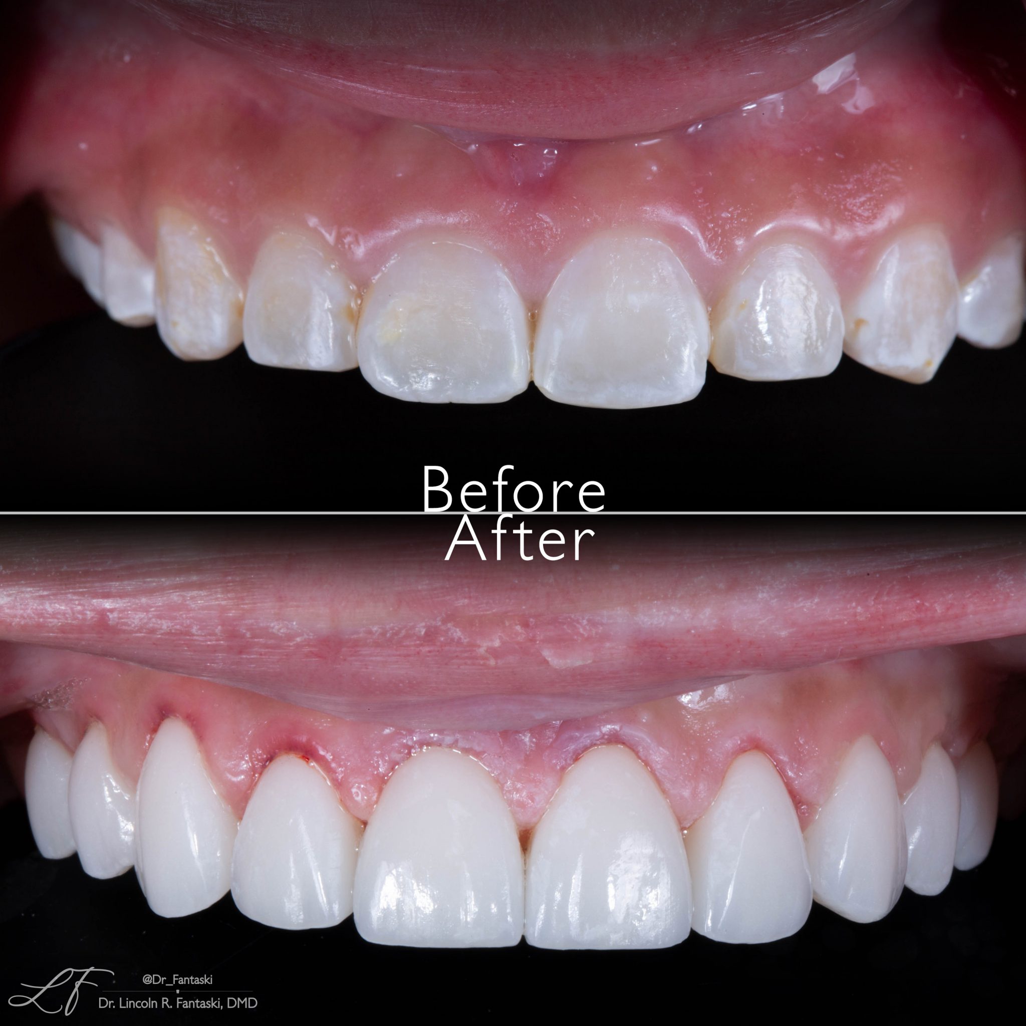 Veneers and Esthetic Crown Lengthening Dr. Fantaski FantaskiSmiles